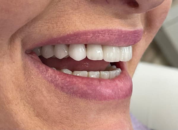 Efekt po – licówki i korony