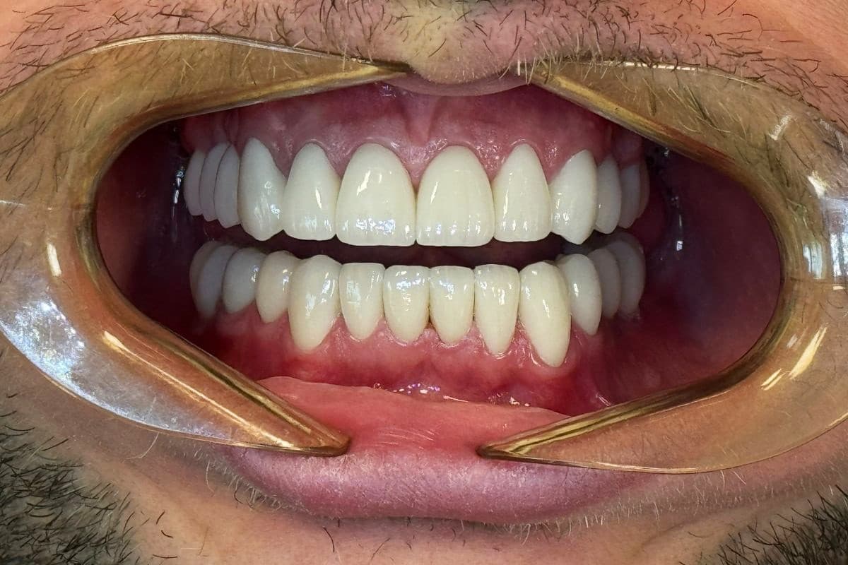 Efekt po – Rekonstrukcja zgryzu i nowy uśmiech